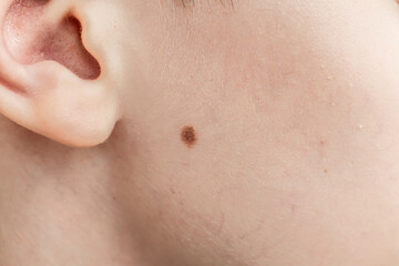 a large mole on the cheek of a teenager in close-up. health care. consultation with a doctor