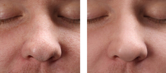 Photos of man before and after acne treatment, closeup. Collage showing affected and healthy skin