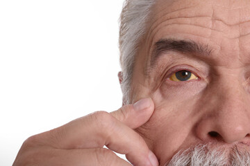 Senior man with yellow eyes on white background, closeup. Symptom of hepatitis