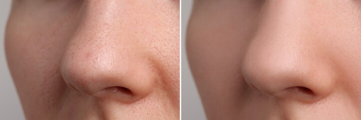 Photos of woman before and after acne treatment, closeup. Collage showing affected and healthy skin