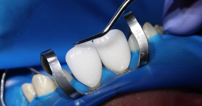 Dentist installs white ceramic veneers using professional equipment. Specialist creates perfect smile for female patient in dental clinic