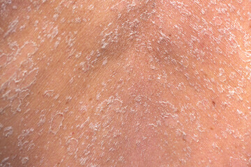 Sunburn, close-up of human skin. Flaky skin from allergies, peeling or eczema. Dry skin in need of treatment and hydration.