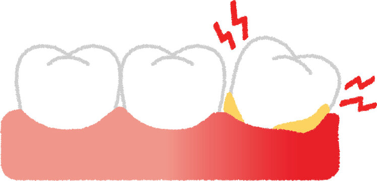 歯槽膿漏のイラスト