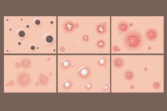 vector collection of types of pimples inside the skin Facial infections, pimples and skin inflammation. Skincare, face acne breakout. Dermatology epidermis