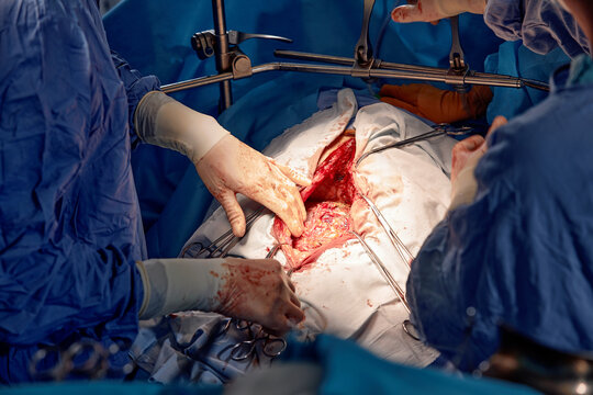 Group of surgeons in the operating room with surgical equipment. Close-up of hands holding surgical instruments. Surgical operation on the internal organs of a person. Real operation