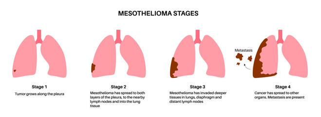 Mesothelioma cancer stages