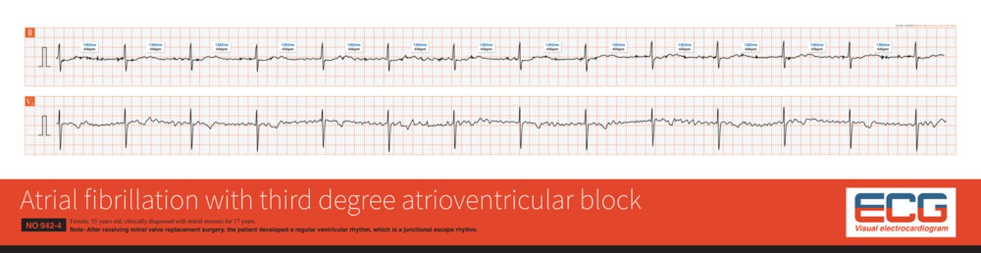 Cardiac surgery is one of the common causes of iatrogenic atrioventricular block. Once atrial fibrillation exhibits a slow and regular ventricular rhythm, it is important to be alert to 3° AVB.