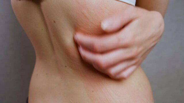 A Caucasian woman strongly combs the reddened skin on her back, covered with blisters. Skin problems, eczema, giardia