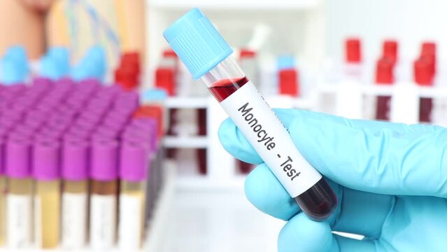 Monocyte test, blood sample to analyze in the laboratory, blood in test tube