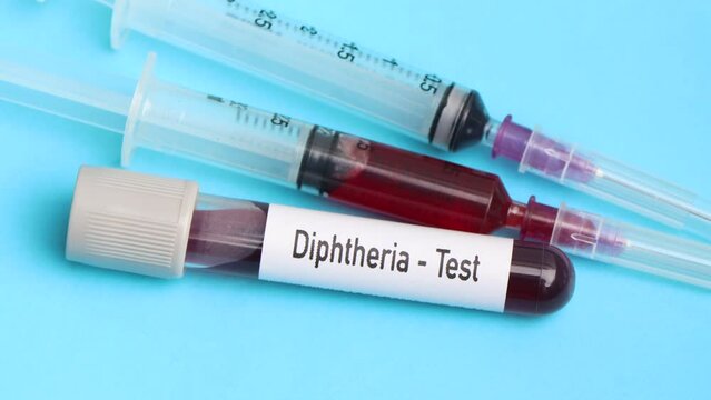 Diphtheria test, blood sample to analyze in the laboratory, blood in test tube