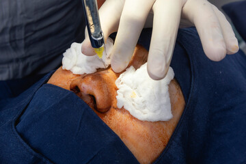 A cosmetic surgeon injects local anesthesia into the bridge of the nose prior to an open rhinoplasty procedure.