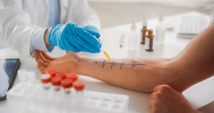 Close Up of a Patient Passing a Prick Scratch Allergy Test. Allergist Using Different Allergens on a Skin of a Young Man. Immunologist Diagnosing Allergy Triggers