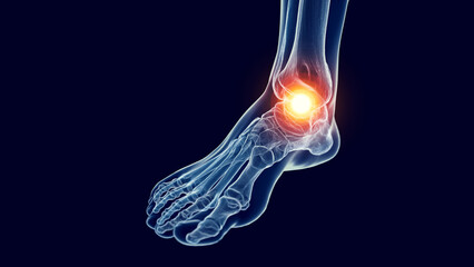 Fototapeta na wymiar 3D Rendered Medical Illustration of foot pain.
