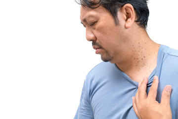middle age senior man with skin tags or acrochordon on his neck isolated on white
