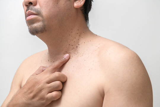 middle age senior man point to skin tags or acrochordon on his neck isolated on white background. Health care