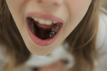 Girl shows her SILVER CROWN (caps). Open mouth close up. Children's dental crowns. stainless steel...