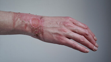 Close-up of a woman's hand with a burst blister from a boiled water burn, broken skin, 1st or 2nd...