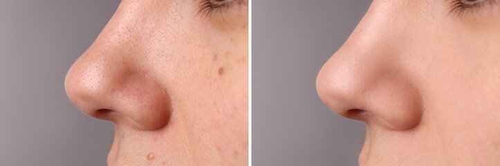 Before and after acne treatment. Photos of woman on grey background, closeup. Collage showing affected and healthy skin