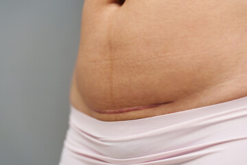 close up belly of woman with c-section scar of caesarean