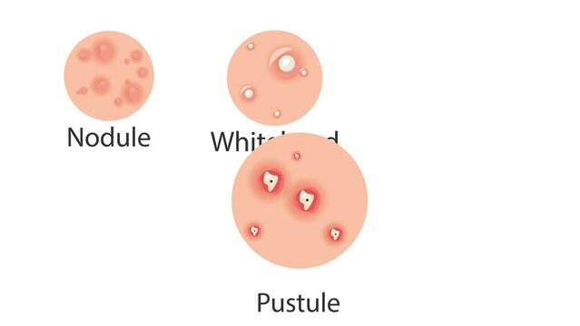 6 types of pimples on human face skin 4k animation white background