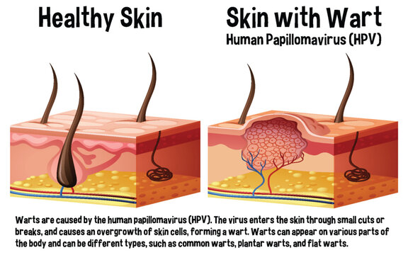 Healthy skin and skin with wart infographic with explanation