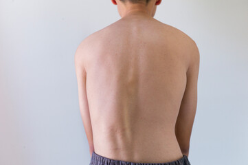 back view of boy with scoliosis, spinal nerve. isolated on white background