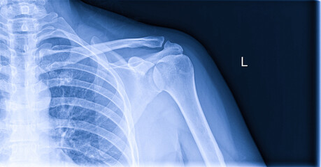 X-ray image of shoulder pain, shoulder ligament tendinitis, shoulder muscle strain - obrazy, fototapety, plakaty