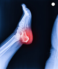 Foot and ankle pain on x-ray, isolated on black background, heel pain, heel spur - obrazy, fototapety, plakaty