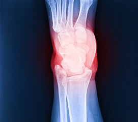 Arthritis at ankle joint (Gout , Rheumatoid arthritis)