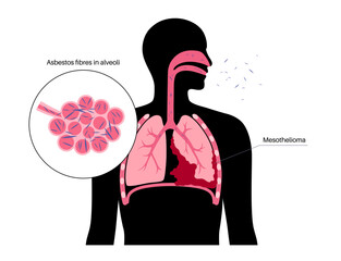 Mesothelioma cancer disease