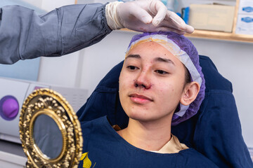 A female patient in her 20s checks the results of augmentation rhinoplasty, tip plasty and...