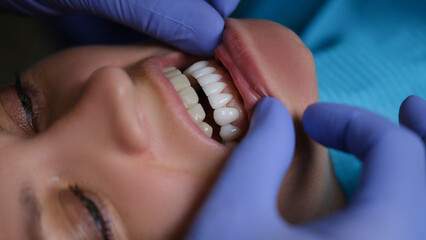 Doctor dentist examining teeth with veneers of female patient in clinic closeup. Dentistry concept - obrazy, fototapety, plakaty