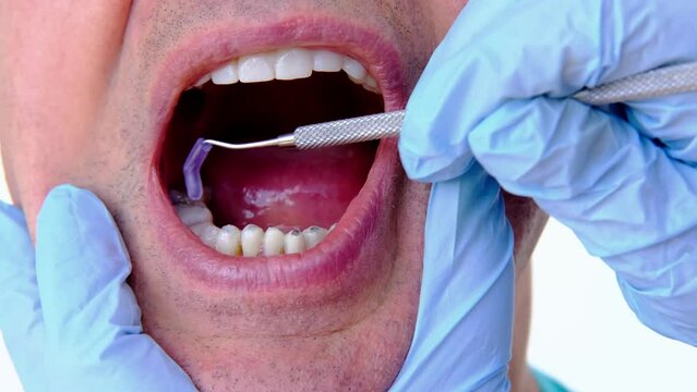 dental prosthetist examines oral cavity patient, charismatic mature man 60 years old open mouth, shows teeth with temporary fillings and metal, titanium pins for prosthetics or splinting, prosthetics