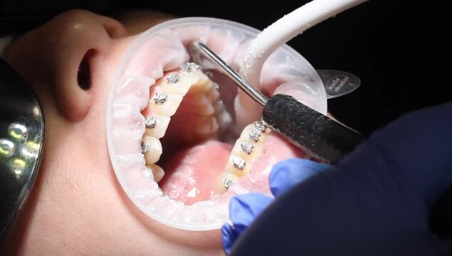 orthodontist using dental tools while cleaning teeth of patient wearing brackets