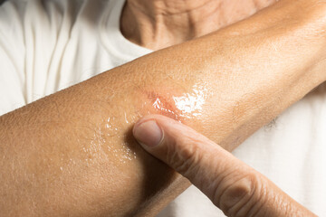 Man applying ointment to a small minor first degree burn on his forearm
