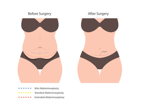 Abdominoplasty tummy tuck surgery. skin fat loss