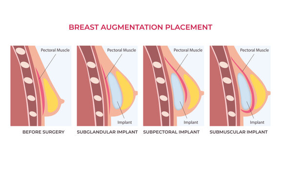 Breast implant types in female silhouette. Subglandular, subpectoral, submuscular placement
