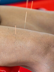 Traditional Chinese acupuncture is where acupuncture is applied to the patient's skin.
