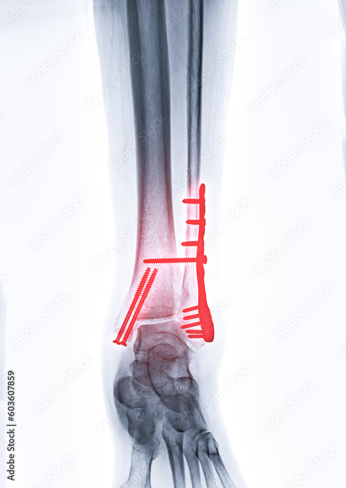 Poster x-ray image of ankle joint showing internal fixation with plate and screw.