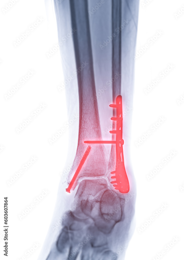 Poster x-ray image of ankle joint showing internal fixation with plate and screw.