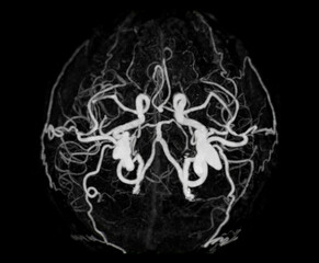CT angiography of the brain or CTA brain showing Cerebral aryery.