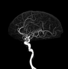 CT angiography of the brain or CTA brain showing Cerebral aryery.