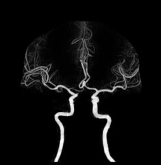 CT angiography of the brain or CTA brain showing Cerebral aryery.