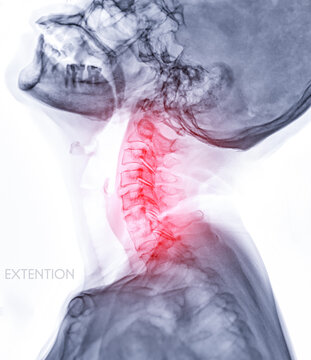 X-ray C-spine or x-ray image of Cervical spine  Extension viewfor diagnostic intervertebral disc herniation ,Spondylosis and fracture.