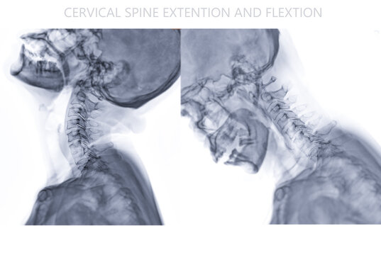 X-ray C-spine or x-ray image of Cervical spine  Flexion and Extension viewfor diagnostic intervertebral disc herniation ,Spondylosis and fracture.