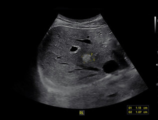 Ultrasound upper abdomen for diagnosis abdominal pain.
