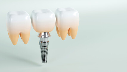 3d rendering of Artificial teeth jaw dentistry implantation, stomatology.dental concept