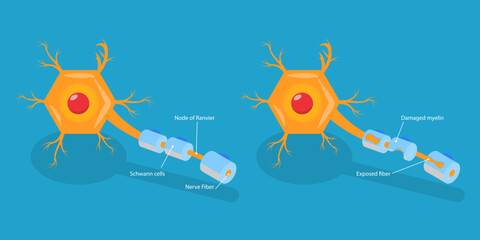 3D Isometric Flat Vector Conceptual Illustration of Multiple Sclerosis, Demyelinating Disease