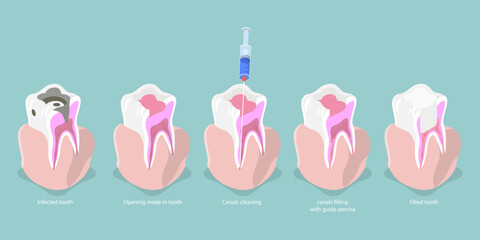3D Isometric Flat Vector Conceptual Illustration of Tooth Decay, Root Canal Treatment Chart