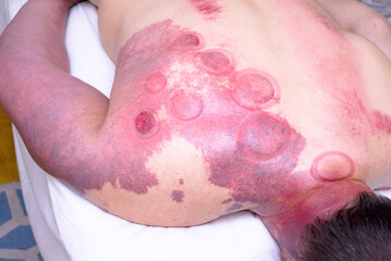 hemangioma of the skin on the back of an adult man, when massaged with cans